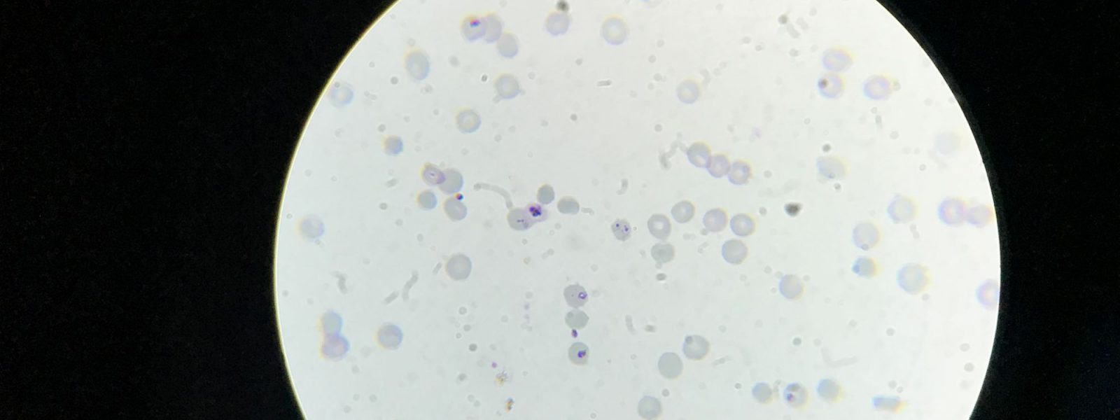 Globules rouges infectés par le parasite du Paludisme